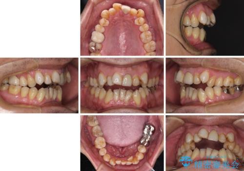 外科手術を検討? 過大な開咬をワイヤー装置とインビザラインで劇的に改善するの治療前