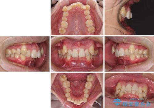 八重歯の抜歯矯正 インビザラインを用いて気になる歯並びを改善の治療前
