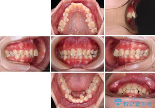 叢生・ディープバイト・突出 ワイヤー装置での抜歯矯正で全てを解決の治療前