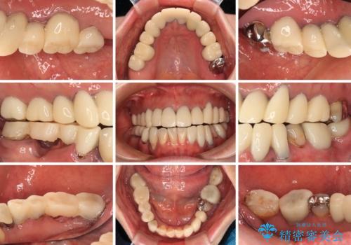 治療を開始したもののうまく噛めない 咬合改善のオールセラミック補綴治療の治療前