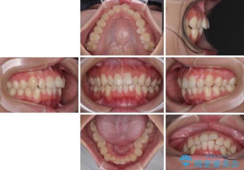 デコボコをワイヤー装置で改善 短期間で綺麗な仕上がりにの治療前