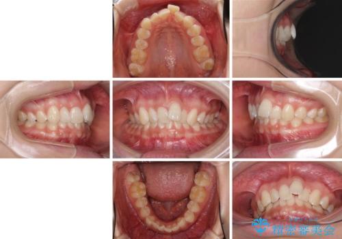 前歯のデコボコを治したい インビザライン矯正治療の治療前