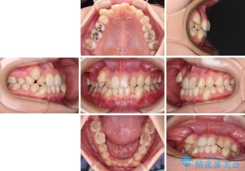 八重歯と正中のズレ ワイヤー装置での抜歯矯正の治療前