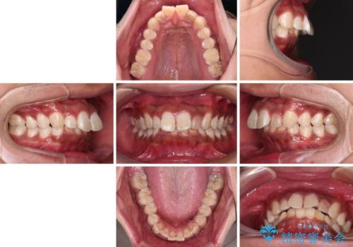 上顎前突とディープバイト ワイヤー矯正での確実に仕上げるの治療前