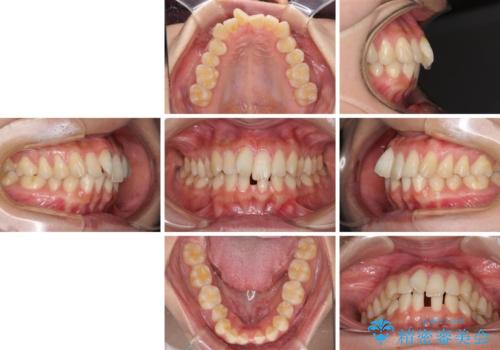 下顎前歯の欠損歯列 ワイヤー装置での矯正治療の治療前