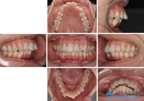 上顎前突で口が閉じにくい ワイヤー装置での抜歯矯正の治療前