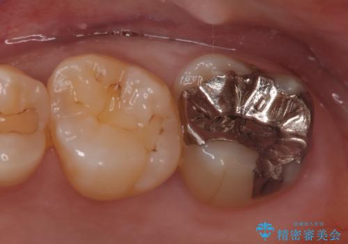 【セラミックインレー】銀の詰め物を白くしたいの症例 治療前