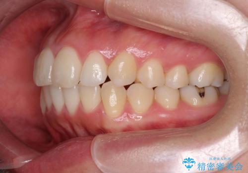 マイクロインプラントで達成する出っ歯の後方移動の治療後