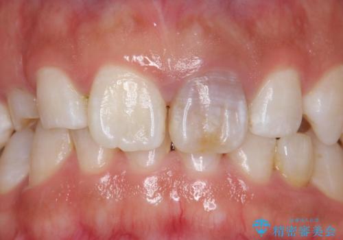 変色した前歯 ジルコニアクラウンでの修復の症例 治療前