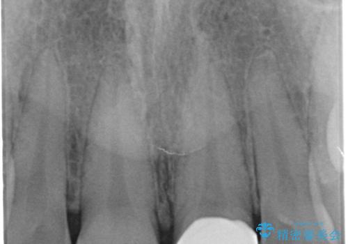 すり減った前歯の形態回復の治療後