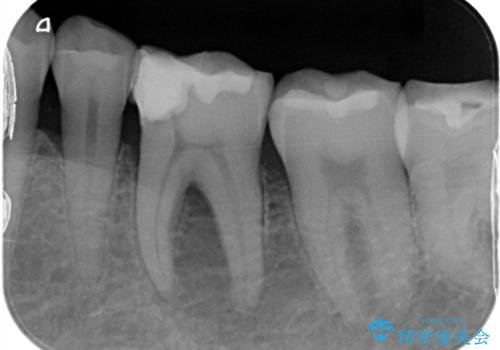 【根管治療】物が当たるだけで痛いの症例 治療前