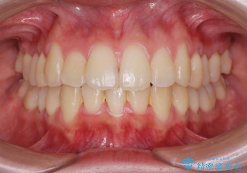 前歯のがたつきをマウスピース矯正できれいに!の症例 治療後