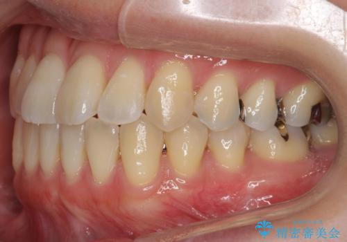 前歯のがたつき 若干受け口 インビザラインでの治療後
