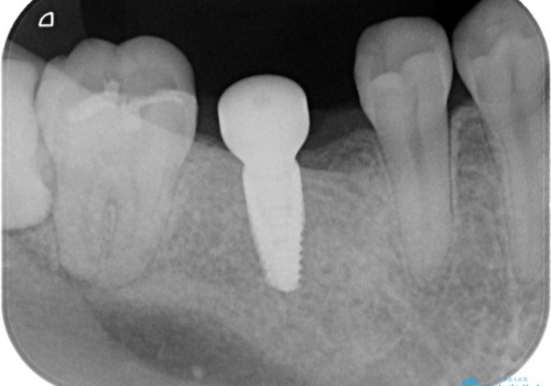 失ったままの臼歯　インプラントによる治療の治療中