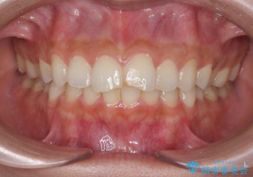 すり減った前歯の形態回復の治療前