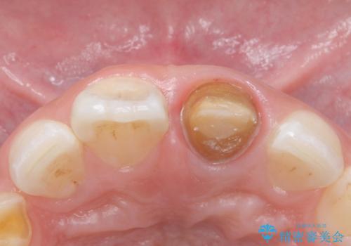 変色した前歯 ジルコニアクラウンでの修復の治療中