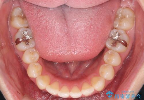 マイクロインプラントで達成する出っ歯の後方移動の治療後