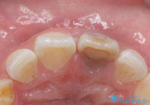 変色した前歯 ジルコニアクラウンでの修復の治療前