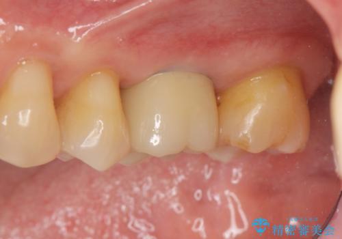 失った咬合機能の回復 インプラント治療の症例 治療後