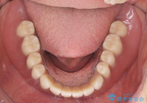 しっかり咬める入れ歯 インプラントオーバーデンチャーの症例 治療後
