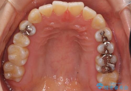 前歯のがたつき 若干受け口 インビザラインでの治療後