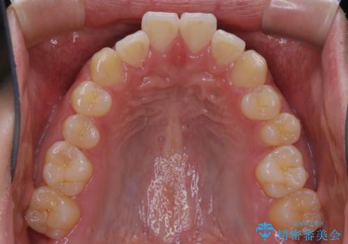 インビザライン矯正 過去に矯正治療したが、また前歯にがたつきがでてきて治したいの治療前
