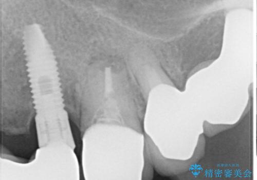 【抜歯即時埋入即時過重】1DAYインプラントの治療前