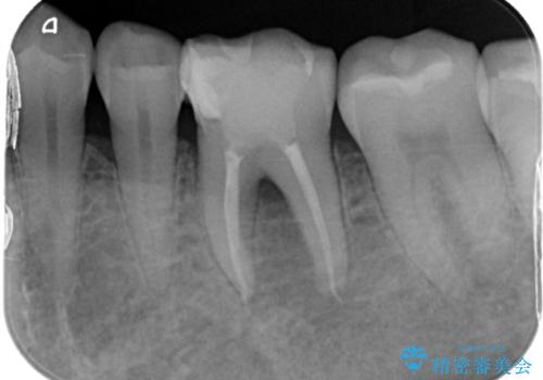 【根管治療】物が当たるだけで痛いの治療中