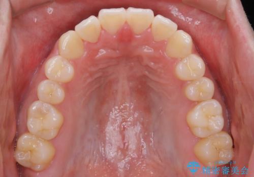 インビザライン矯正 過去に矯正治療したが、また前歯にがたつきがでてきて治したいの治療後