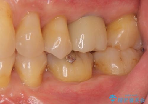失った咬合機能の回復 インプラント治療の治療後