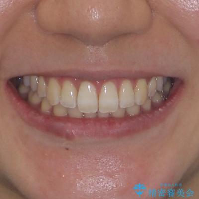 下顎前歯の欠損歯列 ワイヤー装置での矯正治療の治療後(顔貌)