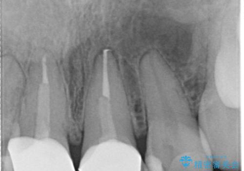 【オールセラミッククラウン】前歯の色が気になる!の治療前