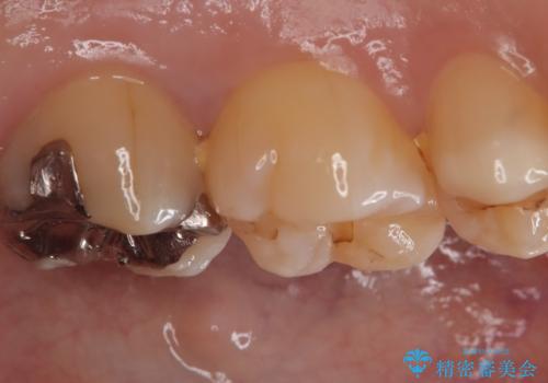 【セラミックインレー】銀の詰め物を白くしたいの治療前