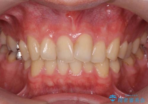 出っ歯と歯のねじれ　非抜歯で　30代男性の症例 治療前