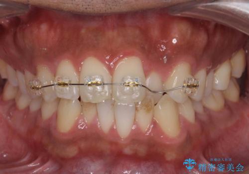 前歯が反対にかんでいる 部分ワイヤーとインビザラインの併用で短期治療の治療中