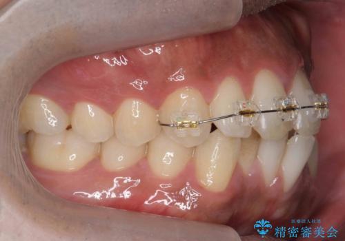 前歯が反対にかんでいる 部分ワイヤーとインビザラインの併用で短期治療の治療中