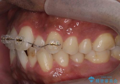 前歯が反対にかんでいる 部分ワイヤーとインビザラインの併用で短期治療の治療中