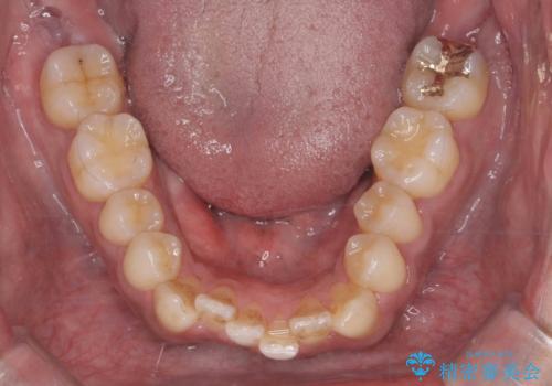 前歯が反対にかんでいる　部分ワイヤーとインビザラインの併用で短期治療の治療中