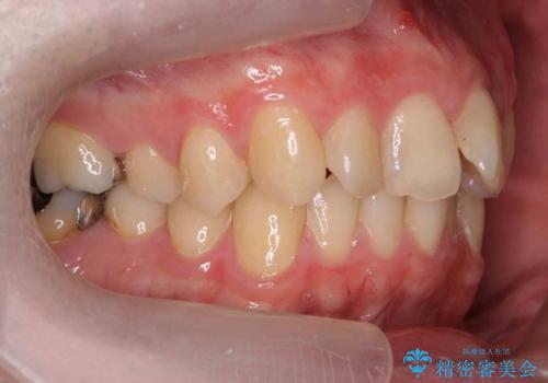 出っ歯と歯のねじれ 非抜歯で 30代男性の治療前