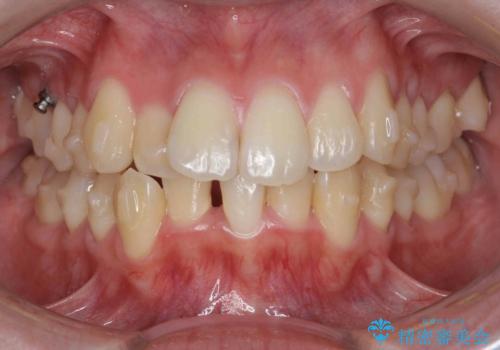 前歯のがたつきをマウスピース矯正できれいに!の治療中