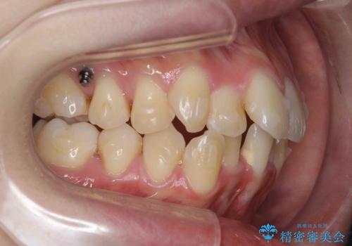 前歯のがたつきをマウスピース矯正できれいに!の治療中