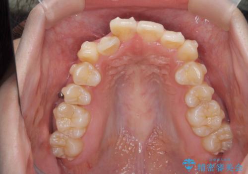 前歯のがたつきをマウスピース矯正できれいに!の治療中