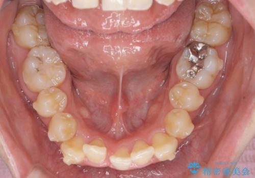 前歯のがたつきをマウスピース矯正できれいに!の治療中