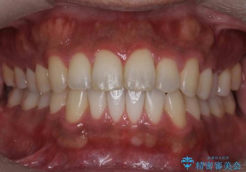 前歯が反対にかんでいる　部分ワイヤーとインビザラインの併用で短期治療の治療後