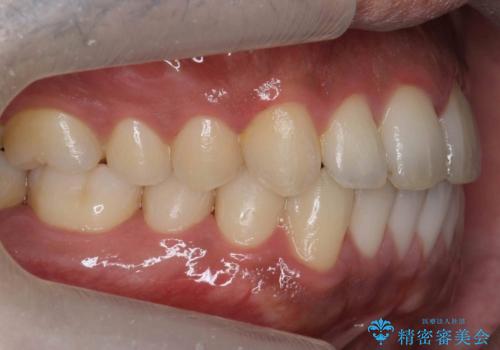 前歯が反対にかんでいる 部分ワイヤーとインビザラインの併用で短期治療の治療後