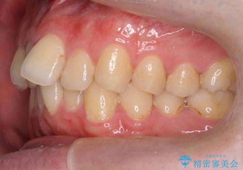 出っ歯と歯のねじれ 非抜歯で 30代男性の治療前