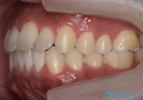 前歯が反対にかんでいる 部分ワイヤーとインビザラインの併用で短期治療の治療後