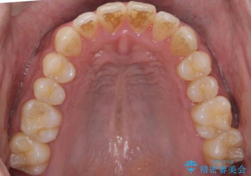 前歯が反対にかんでいる 部分ワイヤーとインビザラインの併用で短期治療の治療後