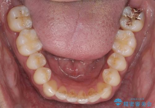 前歯が反対にかんでいる　部分ワイヤーとインビザラインの併用で短期治療の治療後