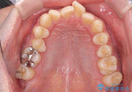出っ歯と歯のねじれ 非抜歯で 30代男性の治療前
